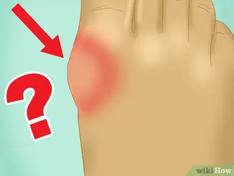 Image titled Stop Gout Pain Step 10