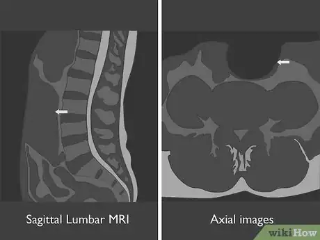 Image titled Read a Lumbar MRI Step 02