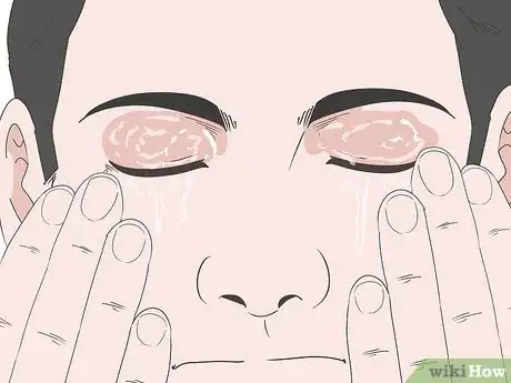 Image titled Soothe Itchy Eyelids Step 3