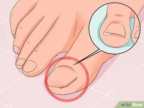 Image titled Remove Infection from an Ingrown Toenail Step 2