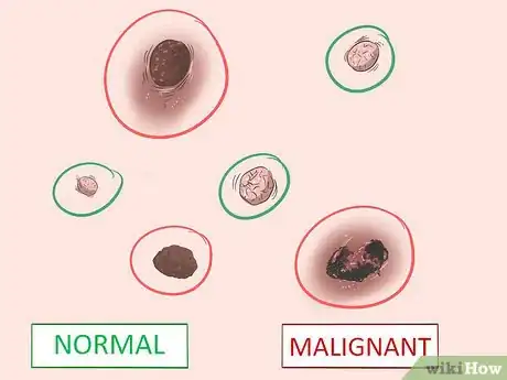 Image titled Recognize Melanoma Step 9