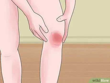 Image titled Tell if You Strained Your Knee Step 1