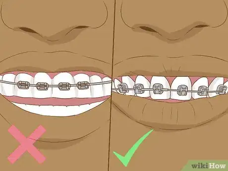 Image titled Make Fake Braces or a Fake Retainer Step 18