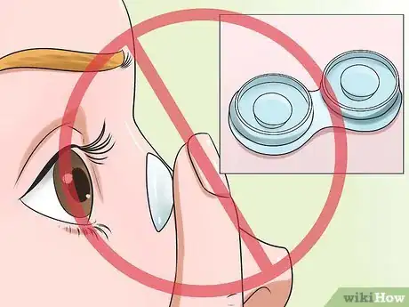 Image titled Treat Pink Eye (Conjunctivitis) Step 10