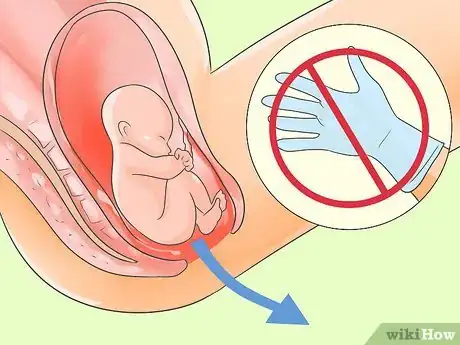 Image titled Deliver a Baby Step 17