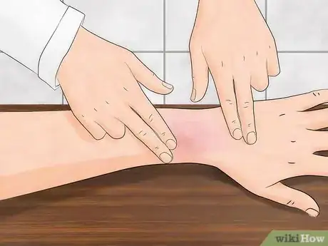 Image titled Get Bug Bites to Stop Itching Step 21