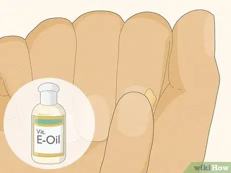 Image titled Get Rid of Hangnails Step 4