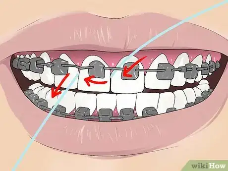 Image titled Floss With Braces Step 3