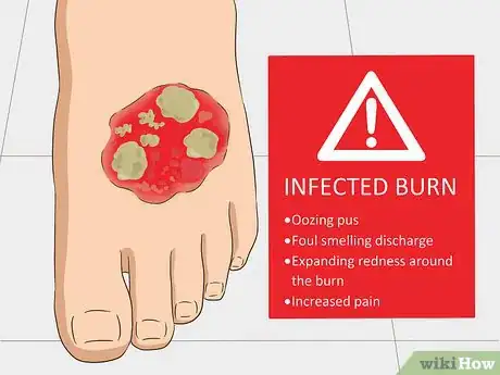 Image titled Prevent Burn Scars Step 5