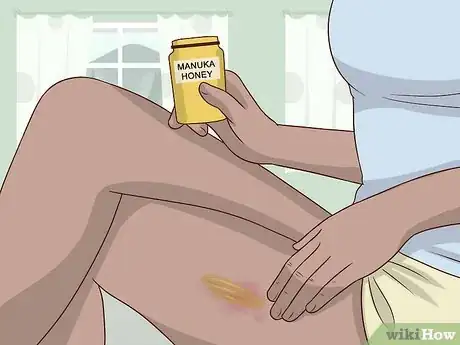 Image titled Treat Eczema Naturally Step 3