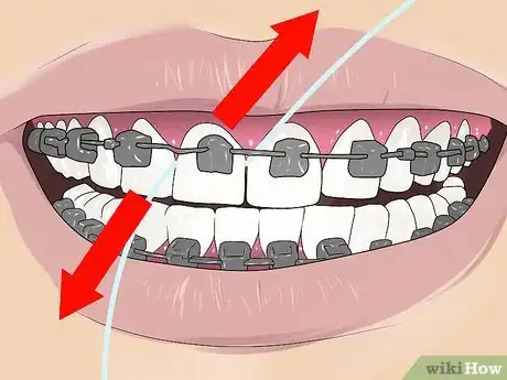 Image titled Floss With Braces Step 4