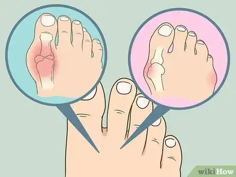 Image titled Soak an Ingrown Toenail Step 10