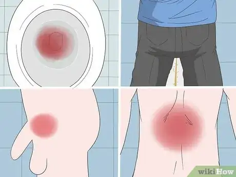 Image titled Locate Your Prostate Step 12