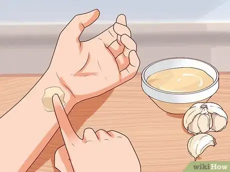 Image titled Remove Warts Naturally Using Garlic Step 1