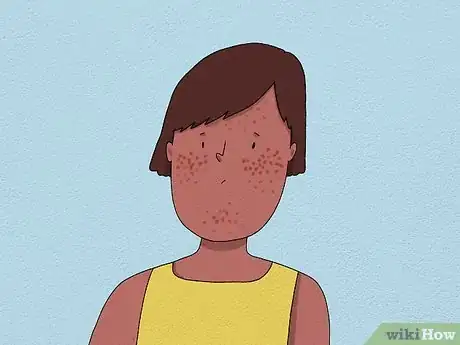Image titled Recognize an Allergic Reaction Step 15