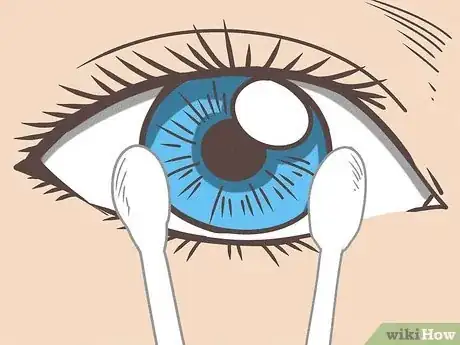 Image titled Remove Contact Lenses with Cotton Swabs Step 8