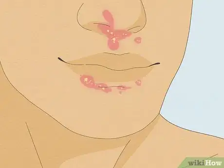 Image titled Get Rid of Dry Skin Under Your Nose Step 8