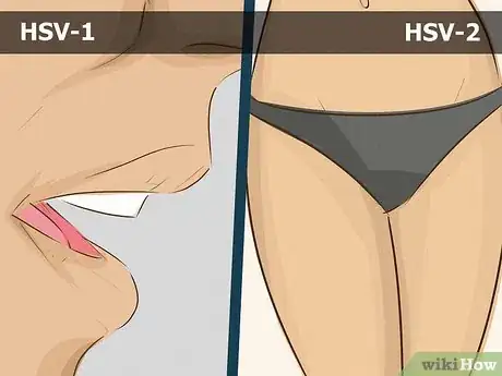 Image titled Date a Girl With Herpes Step 1