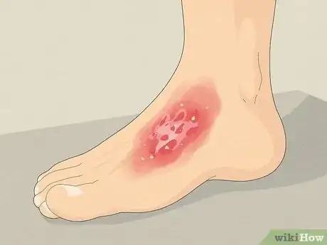 Image titled Use Aloe Vera to Treat Burns Step 12