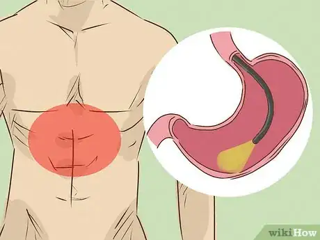 Image titled Cure Gastritis Step 7