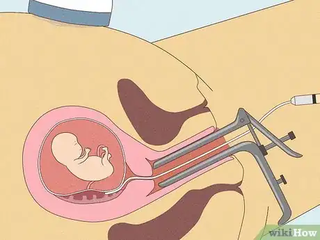 Image titled Tell if a Baby Is a Boy or Girl by the Heartbeat Step 9