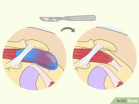 Image titled Treat Subacromial Bursitis Step 20