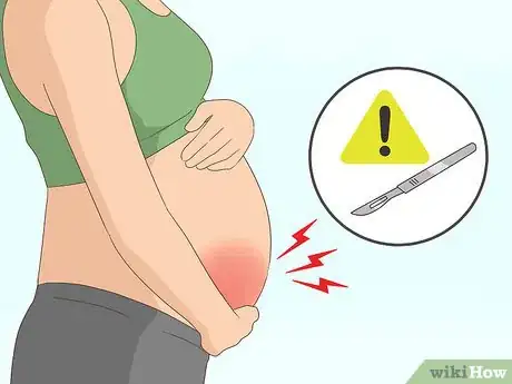 Image titled Deal with Fibroids During Pregnancy Step 5