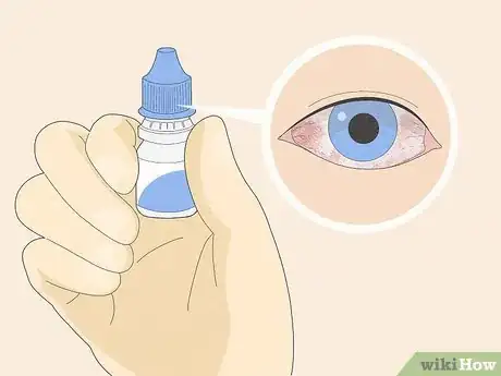 Image titled Administer Eye Drops Step 13