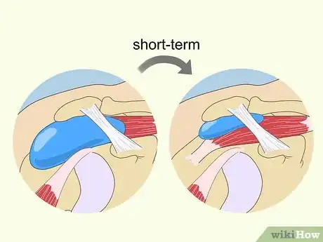 Image titled Treat Subacromial Bursitis Step 21