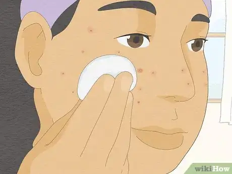 Image titled Pop a Pimple Step 8