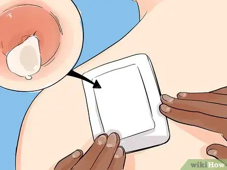 Image titled Treat a Cyst Step 12