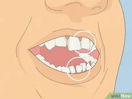 Image titled Straighten Your Teeth Without Braces Step 6