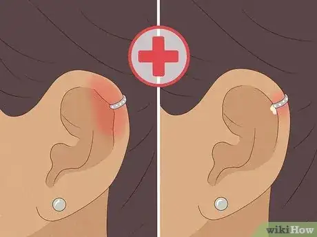 Image titled Treat an Infected Ear Piercing Step 5