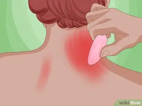 Image titled Perform Gua Sha Step 5