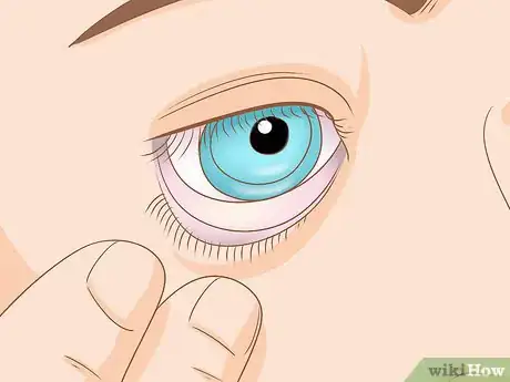 Image titled Insert and Remove a Scleral Lens Step 9