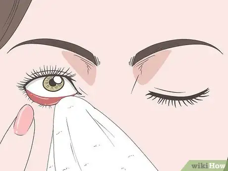 Image titled Treat Blepharitis Step 10