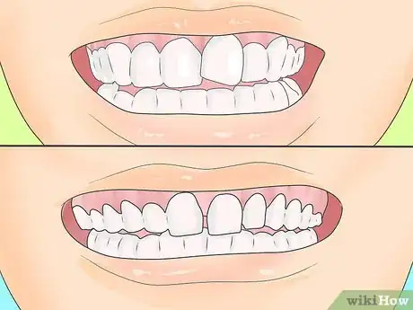 Image titled Persuade Your Parents to Let You Get Braces Step 1