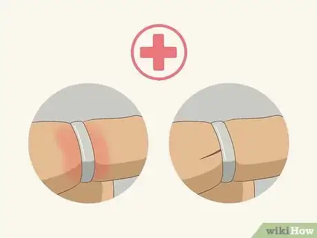 Image titled Remove a Ring in an Emergency Step 13