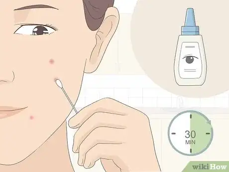 Image titled Get Rid of Acne Redness Fast Step 6