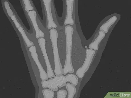 Image titled Diagnose a Broken Thumb Step 8