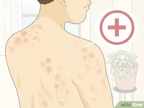 Image titled Recognize Hives (Rash) Step 8