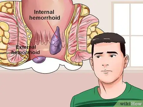 Image titled Stop Hemorrhoid Pain Step 1