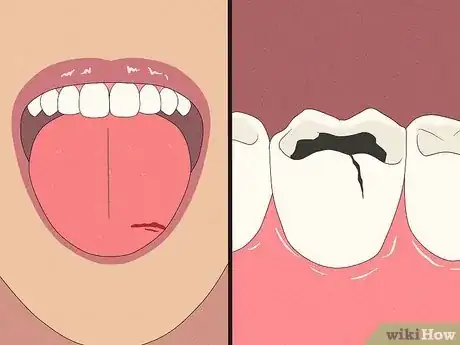 Image titled Treat a Fat Lip Step 1