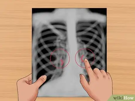 Image titled Read a Chest X Ray Step 20