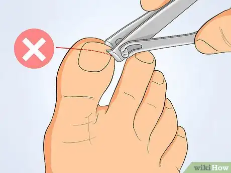 Image titled Tell if an Ingrown Toenail Is Infected Step 8