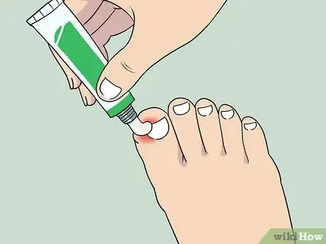 Image titled Soak an Ingrown Toenail Step 5