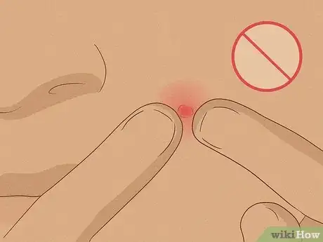 Image titled Get Rid of Pimples Naturally (Sea Salt Method) Step 8
