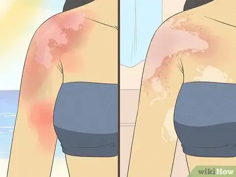 Image titled Diagnose Vitiligo Step 4