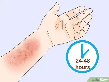 Image titled Get Rid of Poison Ivy Rashes Step 1