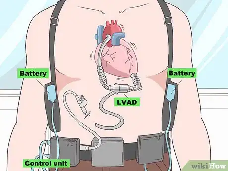 Image titled Treat Myocarditis Step 11